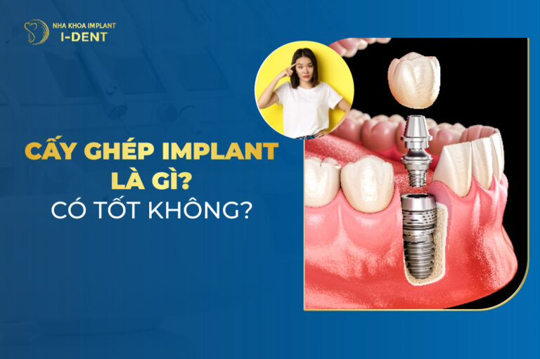 Kỹ thuật cấy ghép implant là gì? Lưu ý trước khi cấy Kỹ thuật cấy ghép implant là gì? Lưu ý trước khi cấy
