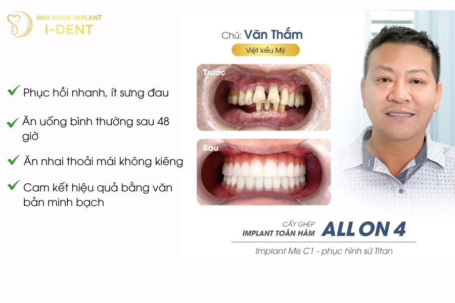 trồng implant