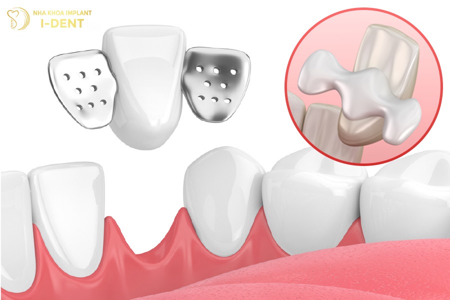 các phương pháp trồng răng
