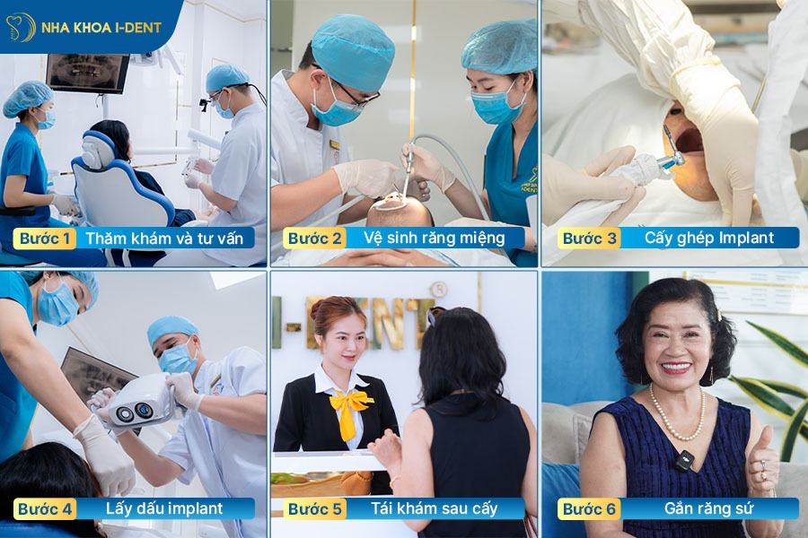 quy trình cắm implant