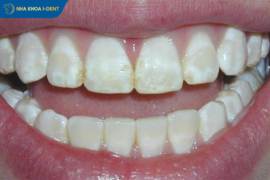 răng bị bể lớn có bọc sứ được không