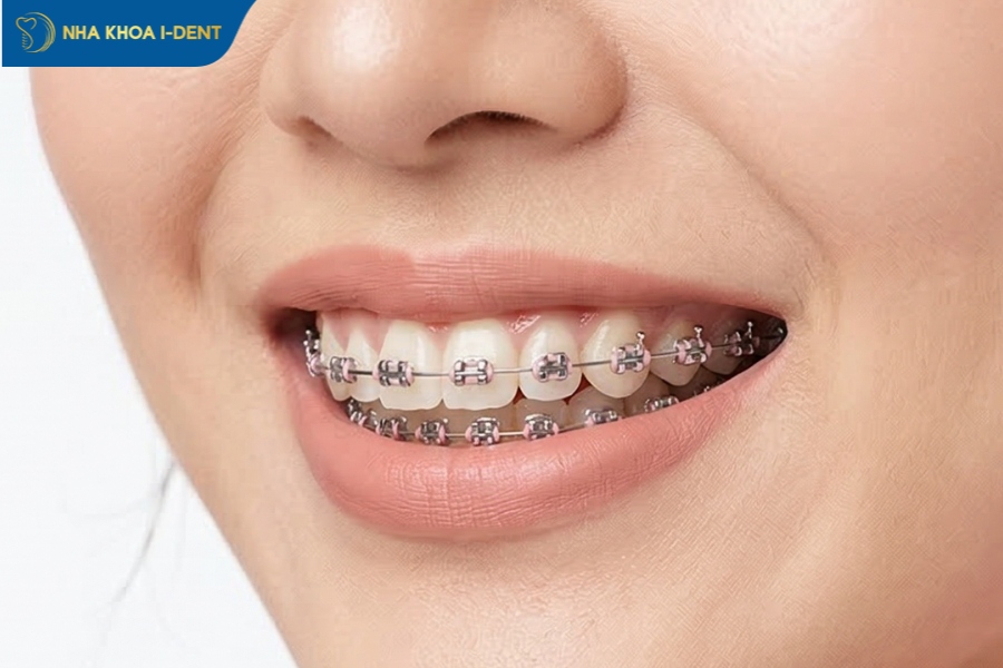 răng hô nhẹ có phải nhổ răng