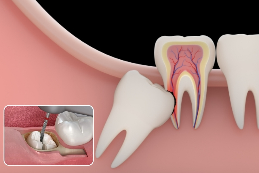 răng khôn bị đau có nên nhổ không