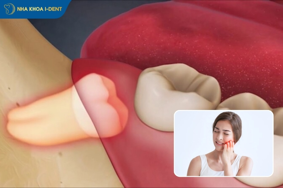 răng khôn đau có nhổ được không