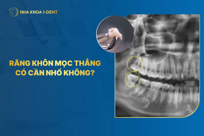 Răng khôn mọc thẳng có cần nhổ không