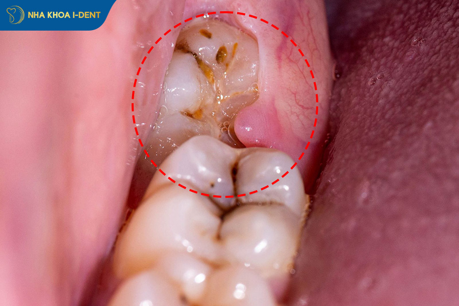 Răng khôn mọc thẳng có nên nhổ không