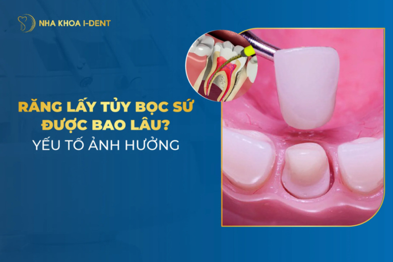 răng lấy tủy bọc sứ được bao lâu