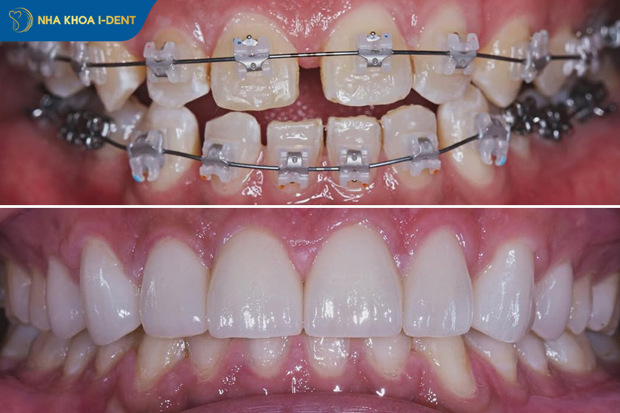 răng thưa có niềng được không