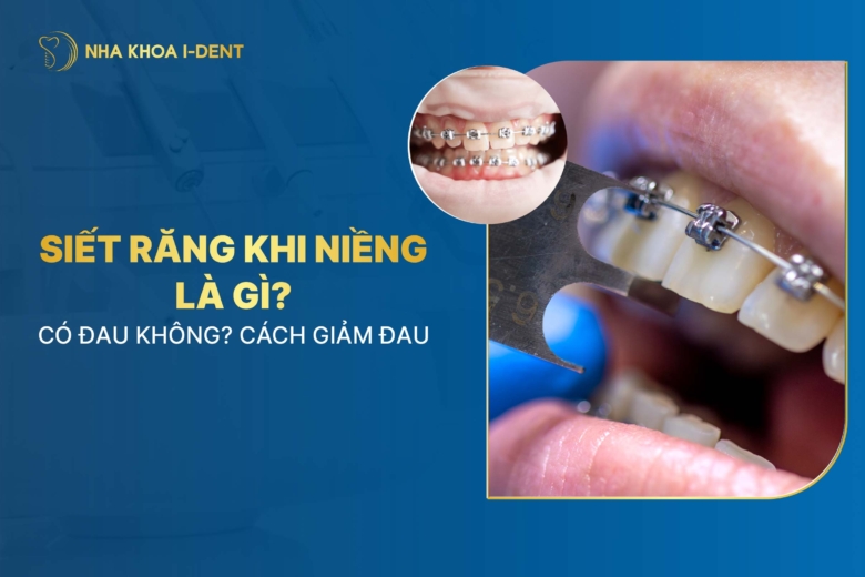Siết Răng Khi Niềng Là Gì? Đau Không? Bao Lâu Siết 1 Lần?