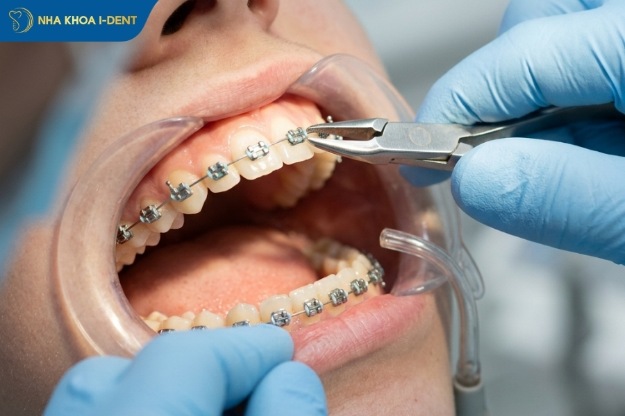 siết răng khi niềng
