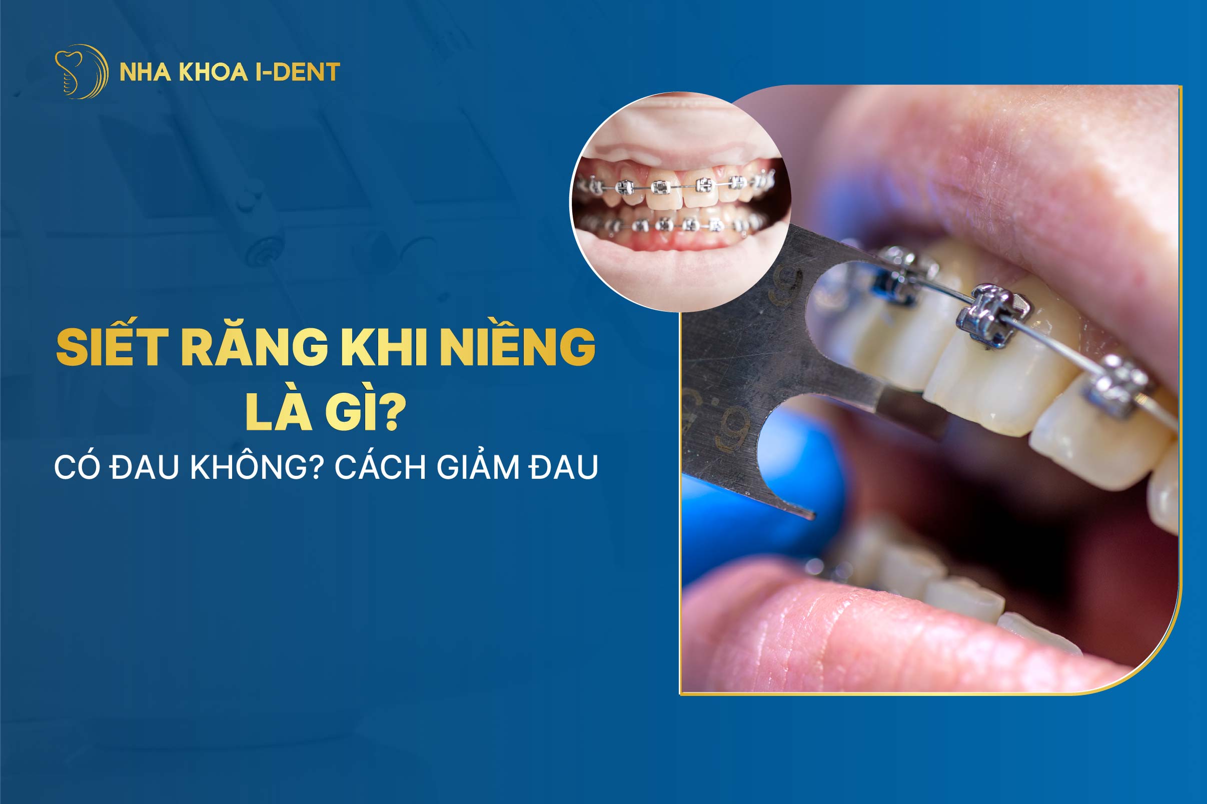 Siết răng khi niềng là gì? Có đau không? Cách giảm đau