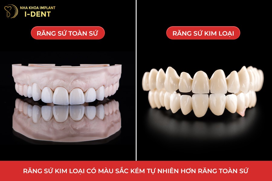 Răng sứ kim loại không đẹp tự nhiên bằng răng toàn sứ.