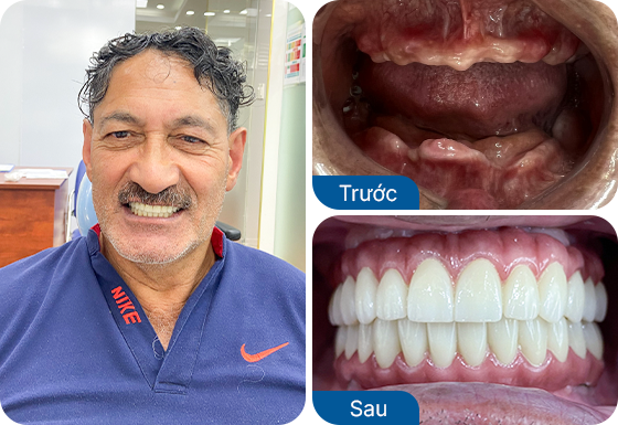 teeth-implants-mark-waetford