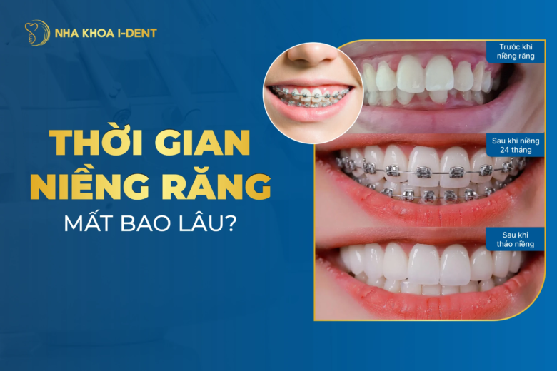 Thời Gian Niềng Răng Mất Bao Lâu
