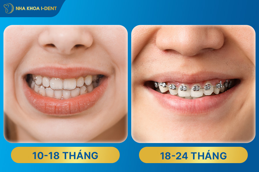 nên niềng răng trong suốt hay mắc cài