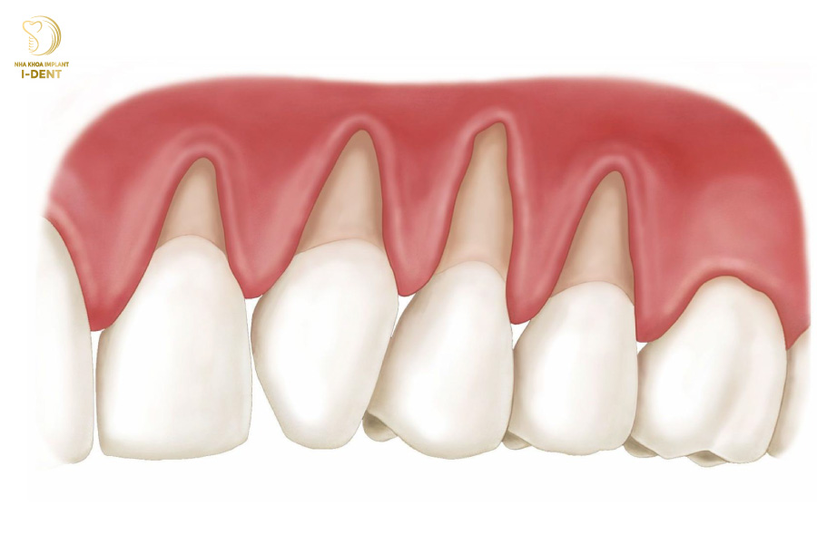 làm cầu răng sứ có bị tiêu xương không