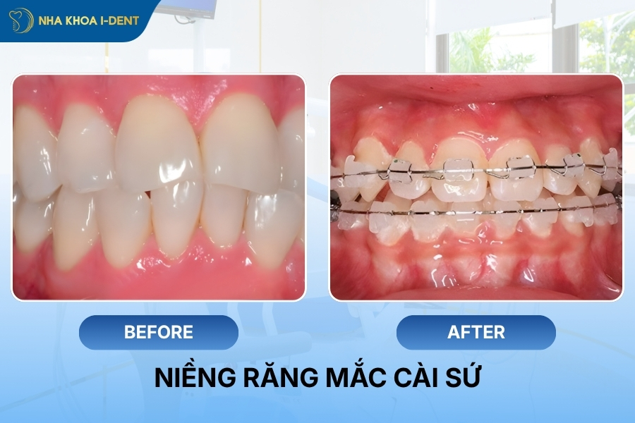 tổng chi phí niềng răng