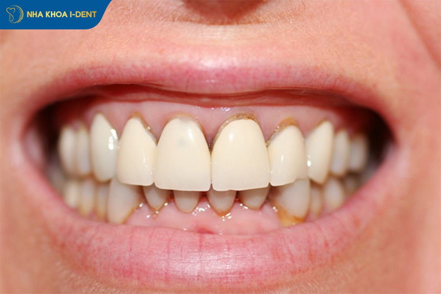 triệu chứng sau khi bọc răng sứ