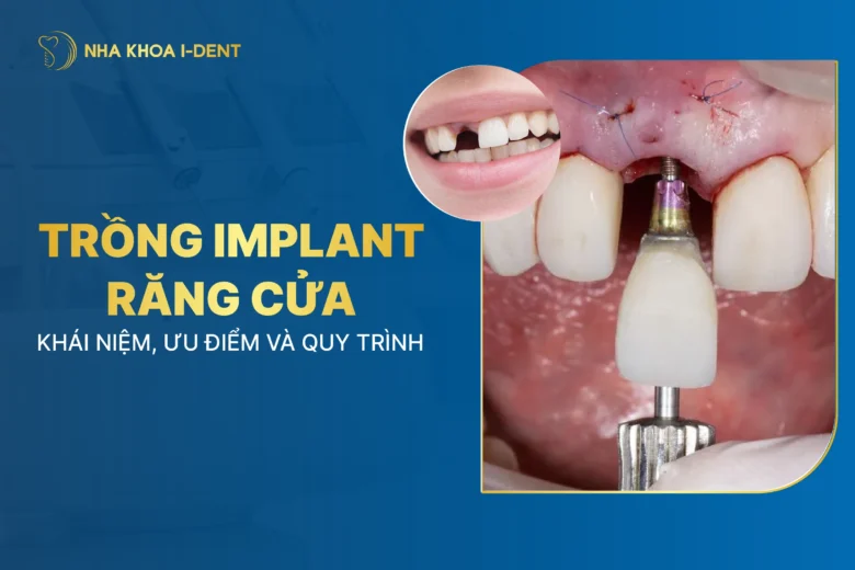 Trồng Implant Răng Cửa: Khái Niệm, Ưu Điểm, Quy Trình Và Giá
