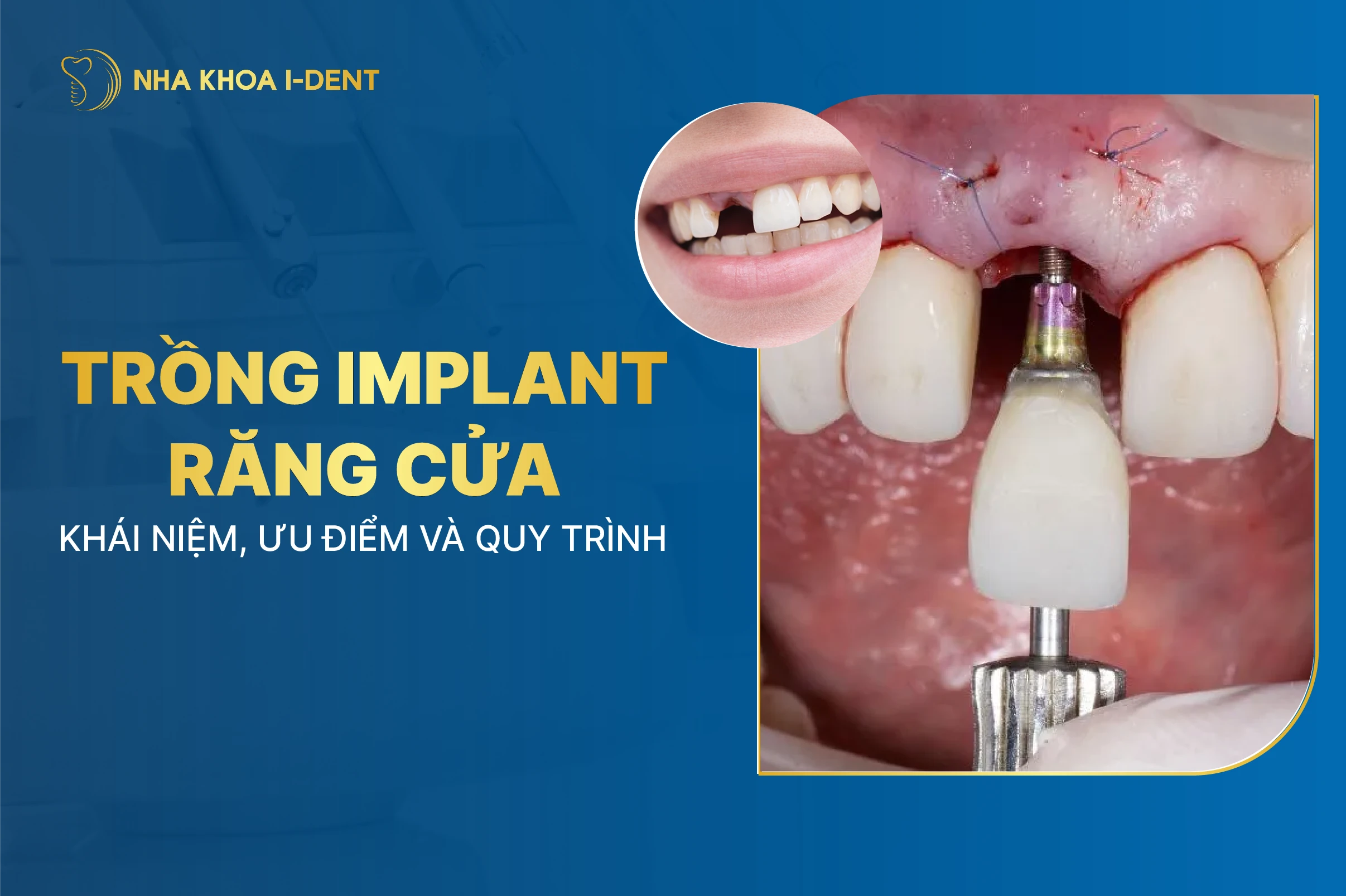 Trong Implant Rang Cua