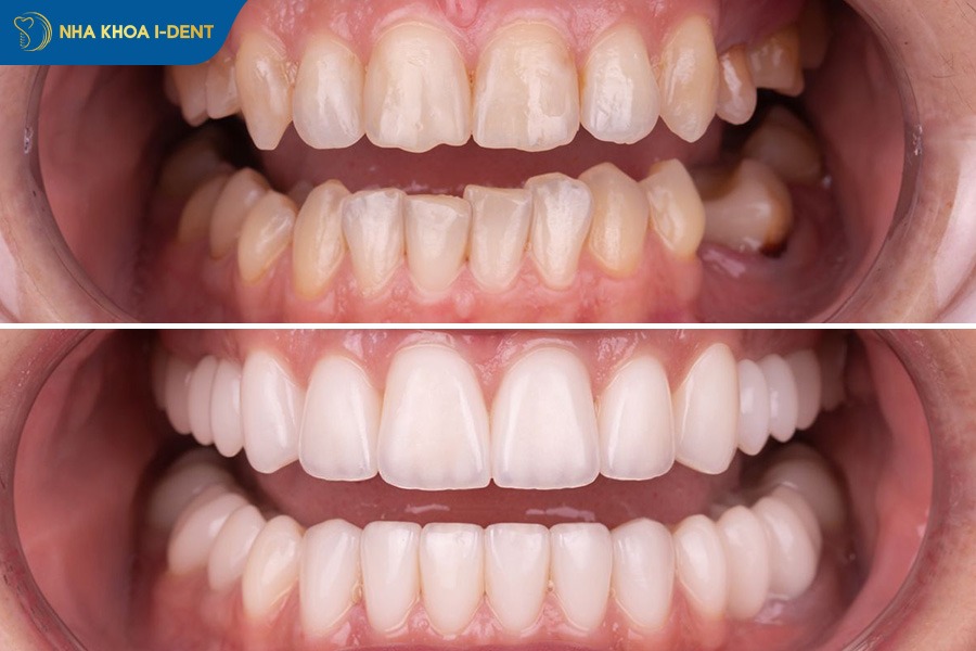 trước và sau khi bọc răng sứ