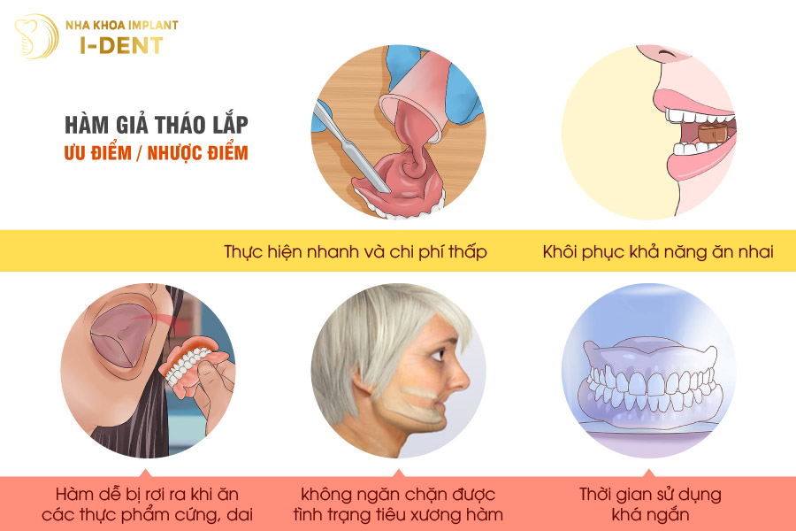 các loại trồng răng