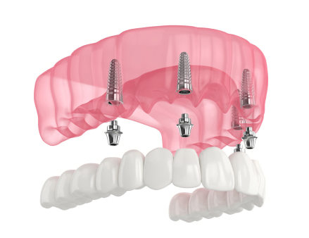 All-on-4 Dental Implant Treatment