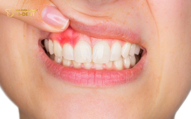 làm răng sứ có ảnh hưởng gì không