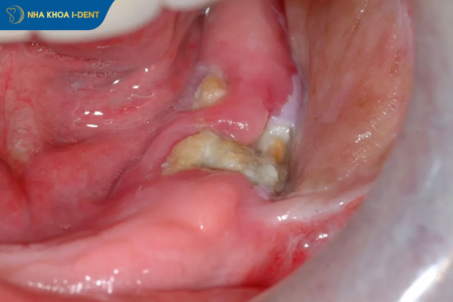 xuất hiện màng trắng sau khi nhổ răng 
