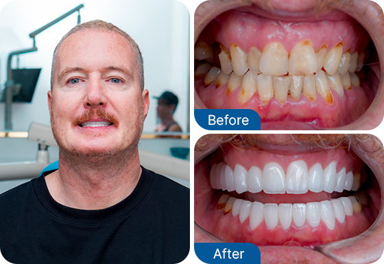 full set of dental implants