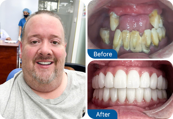 full mouth dental implants
