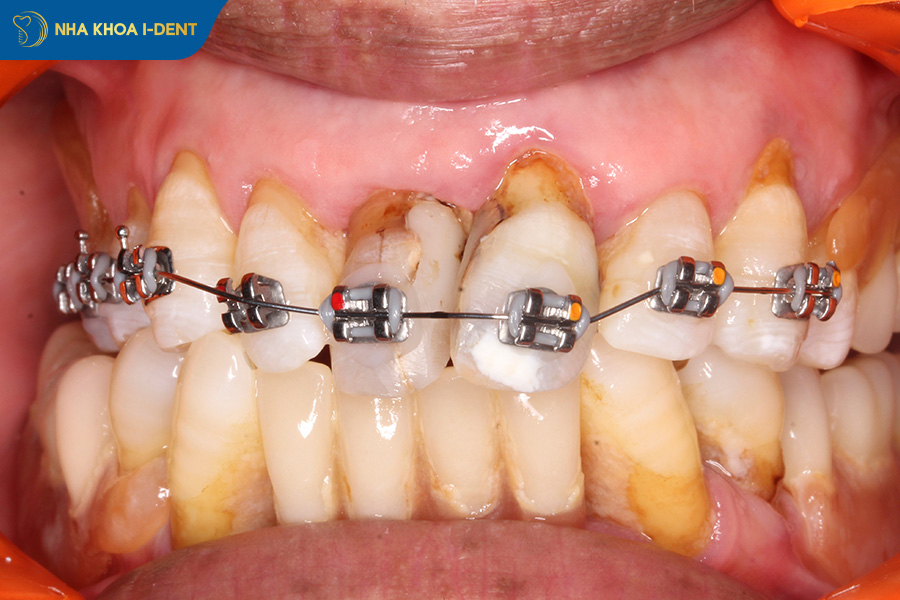 bị tụt nướu sau quá trình niềng răng