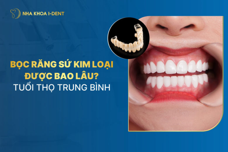 Bọc răng sứ kim loại được bao lâu? Tuổi thọ trung bình