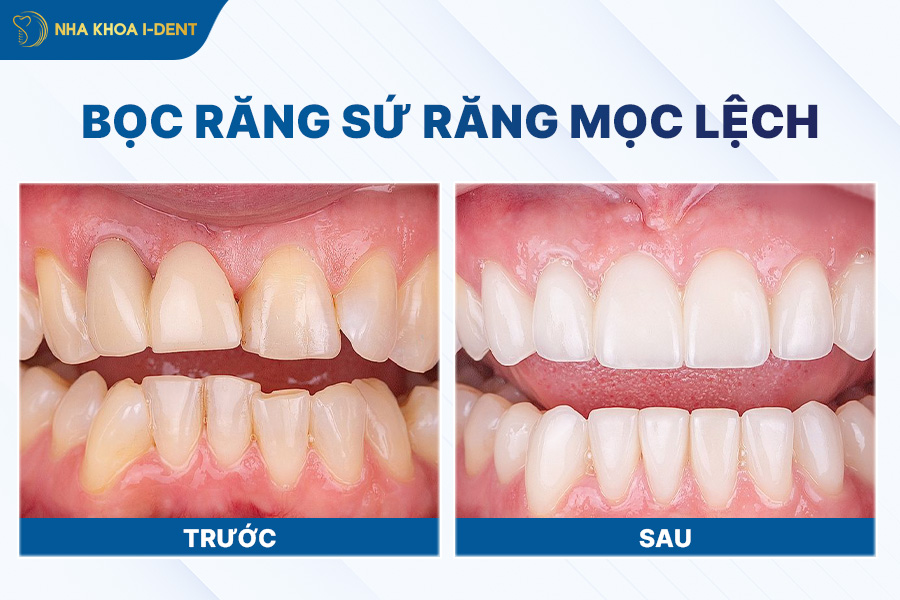 bọc răng sứ chỉnh răng mọc lệch