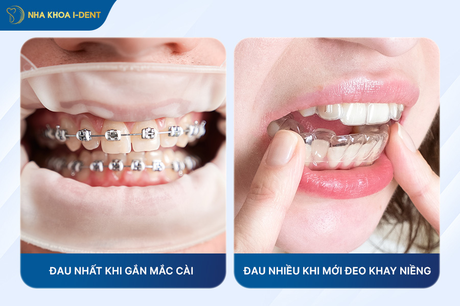 niềng răng đau nhất giai đoạn nào