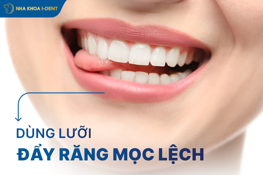 chỉnh răng mọc lệch không cần niềng