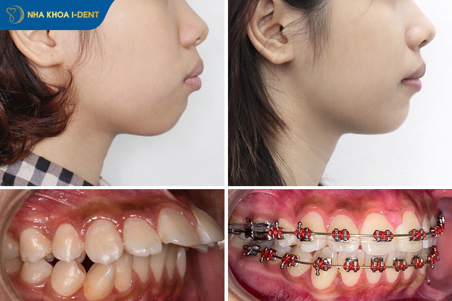 góc nghiêng khuôn mặt trước và sau khi niềng