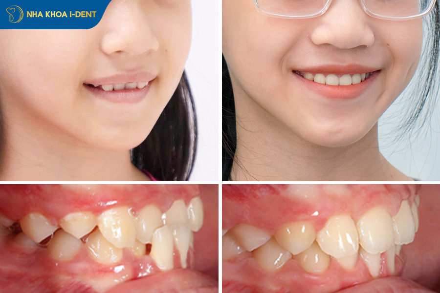 Sự thay đổi góc nghiêng trước và sau khi niềng răng móm