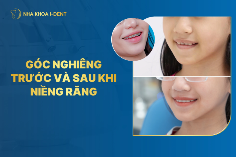 óc nghiêng trước và sau khi niềng răng thay đổi như thế nào