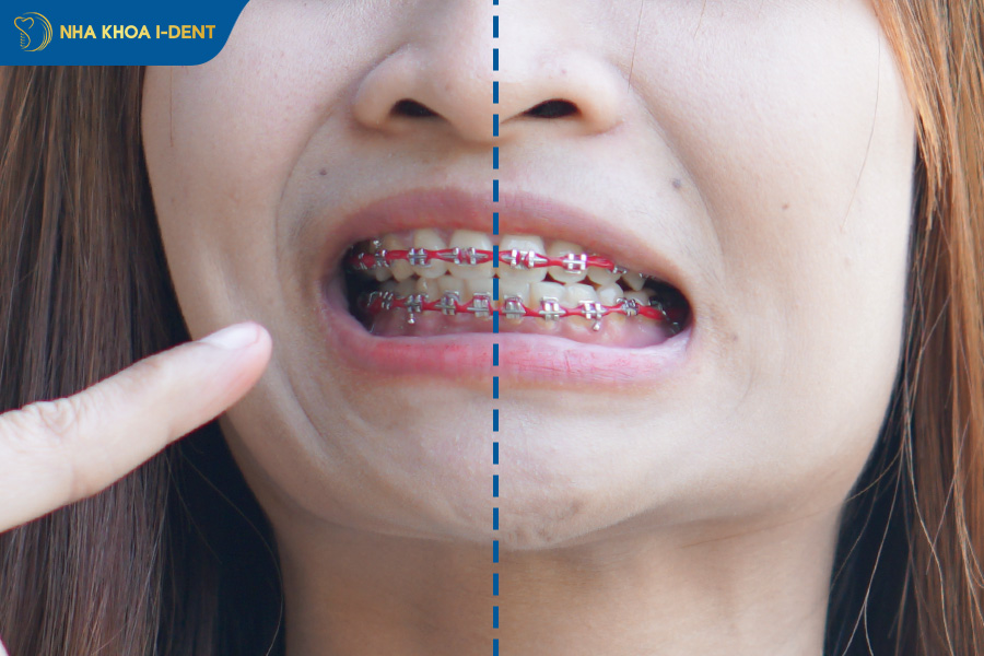 lệch mặt, lệch đường giữa