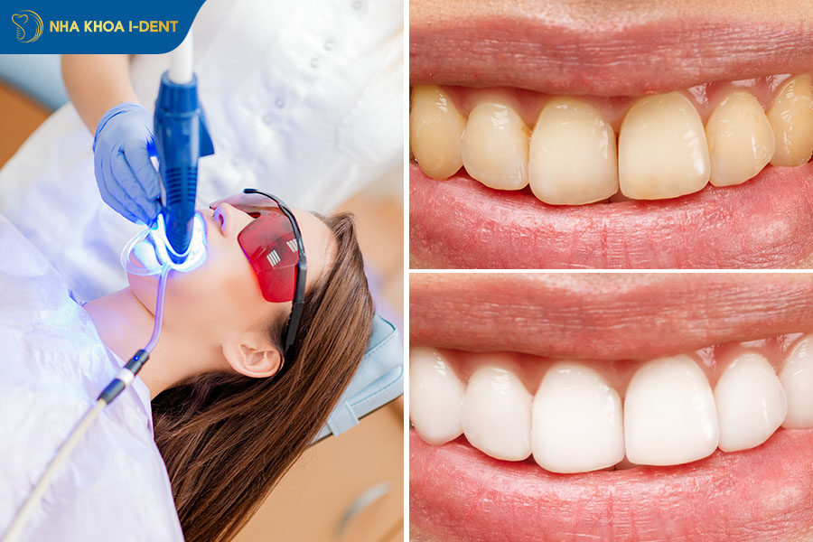 lưu ý gì sau khi tẩy trắng răng