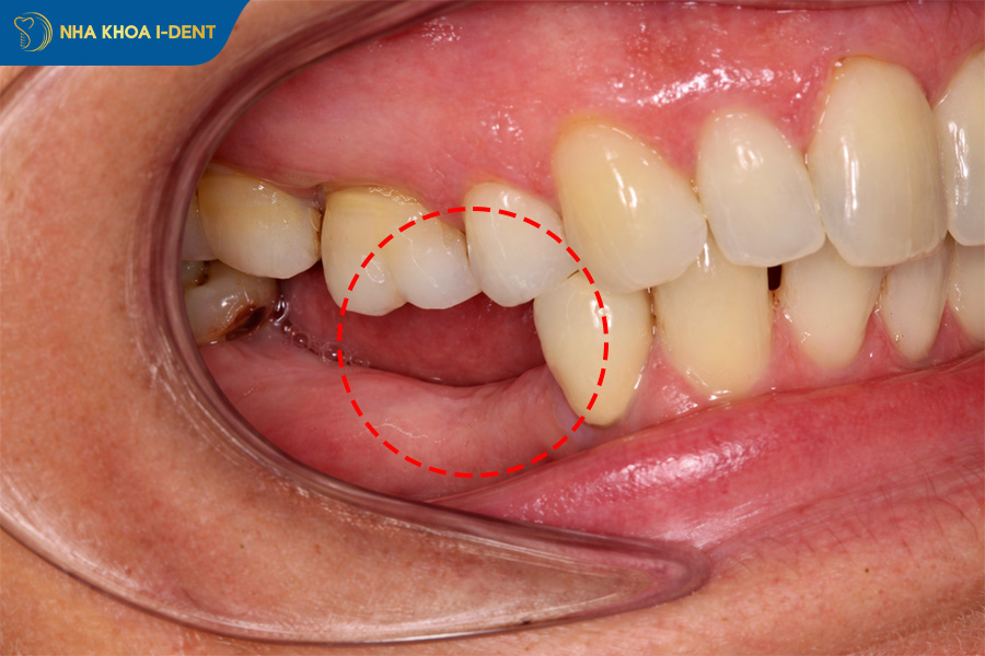 tiêu xương hàm khi mất răng số 6 hàm dưới