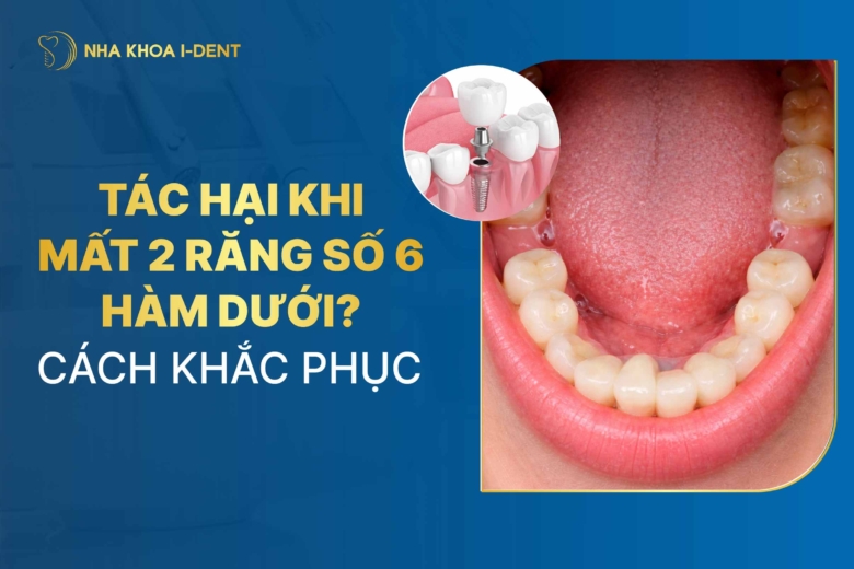 Tác hại khi mất 2 răng số 6 hàm dưới? Cách khắc phục