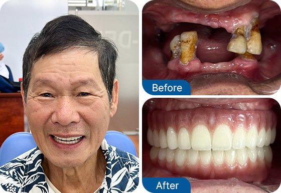 whole mouth implants