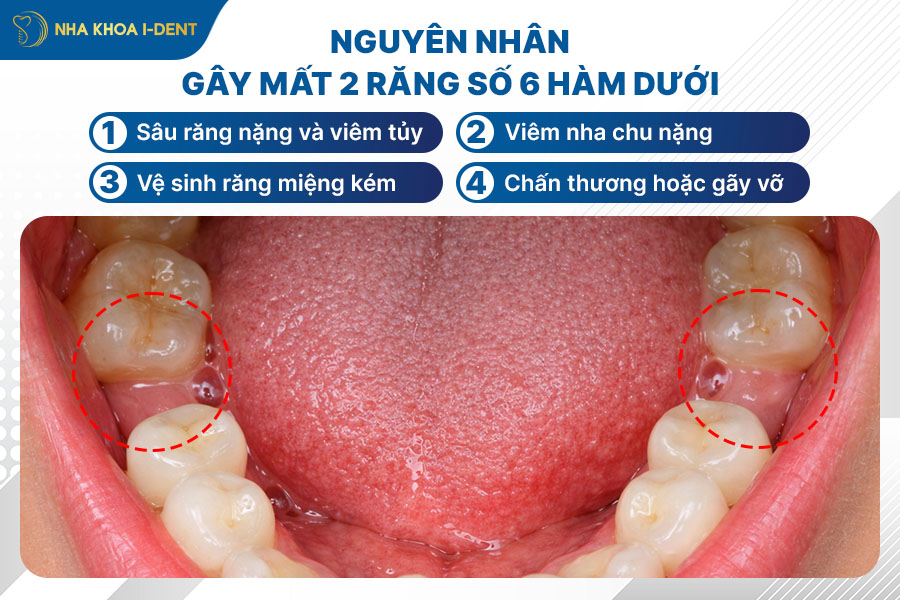 mất 2 răng số 6 hàm dưới