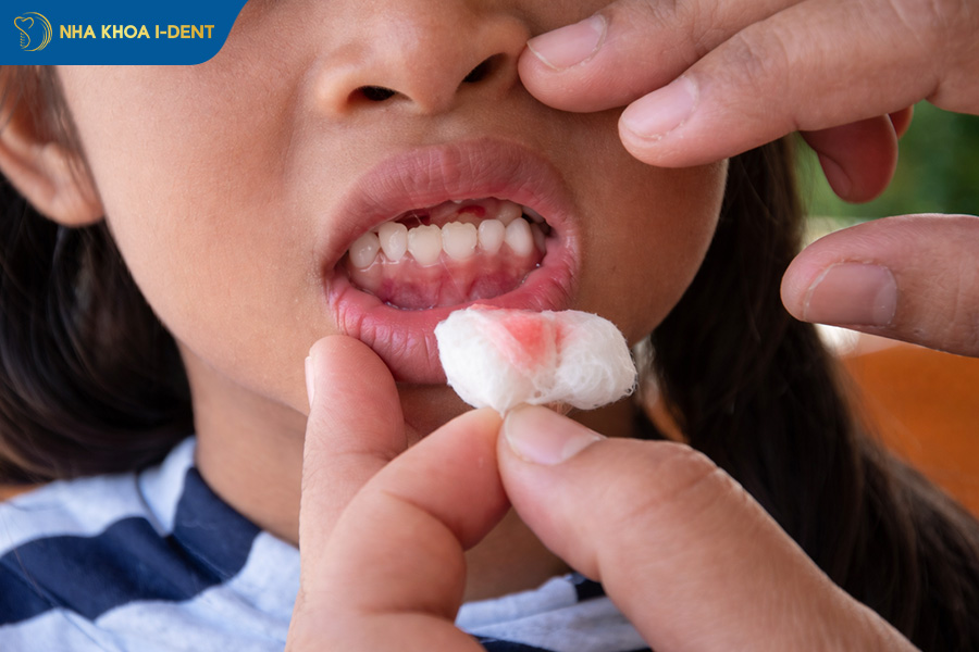 nhổ răng tại nhà