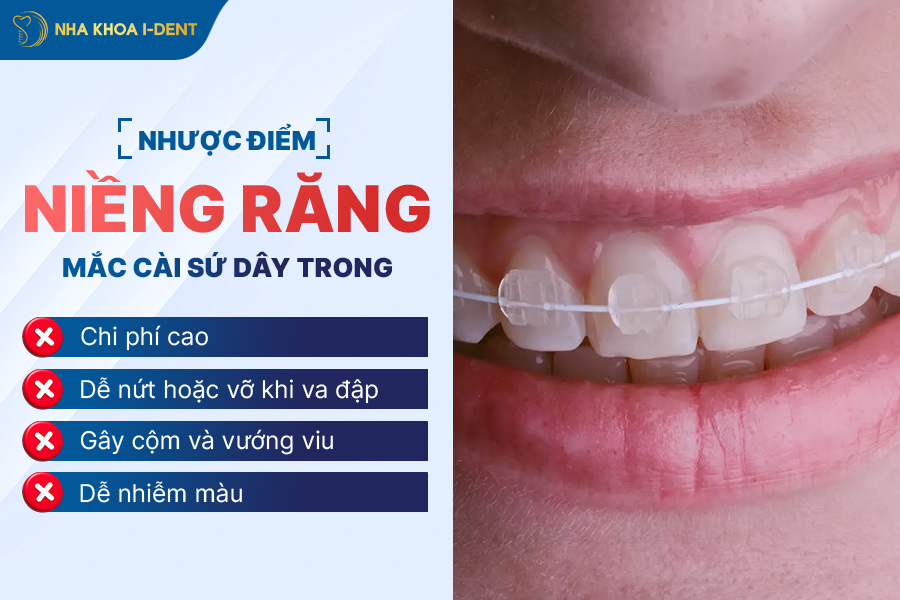 nhược điểm niềng răng mắc cài sứ dây trong