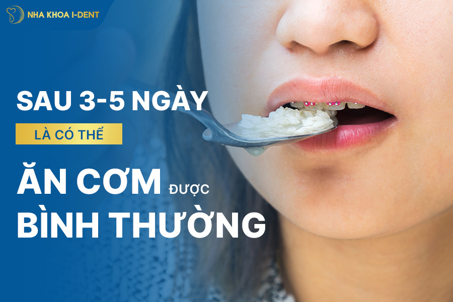 niềng răng bao lâu thì ăn được cơm