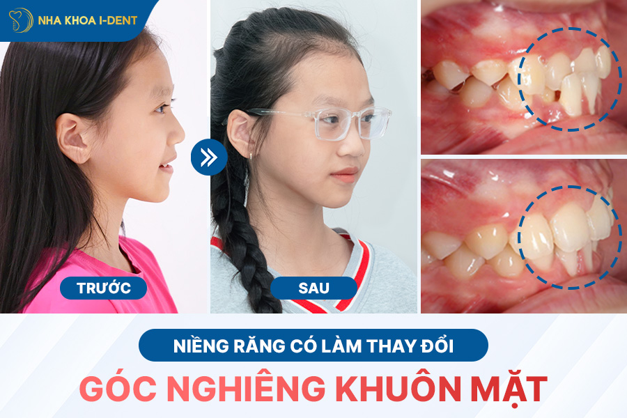 Niềng răng có thể hoàn toàn làm thay đổi góc nghiêng khuôn mặt