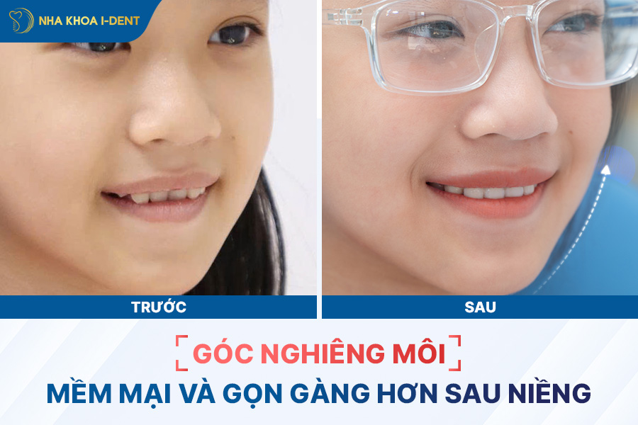 Sự thay đổi môi theo góc nghiêng trước và sau khi niềng răng